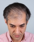Before Hair Transplant&nbsp;2 Sessions (Areas)